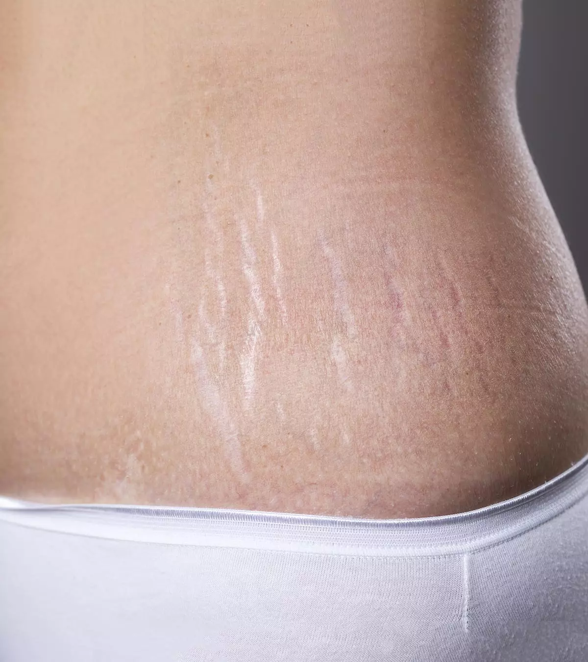 How To Remove Stretch Marks After Pregnancy 16 Home Remedies And Medical Treatments